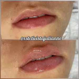 Hydragloss Lips